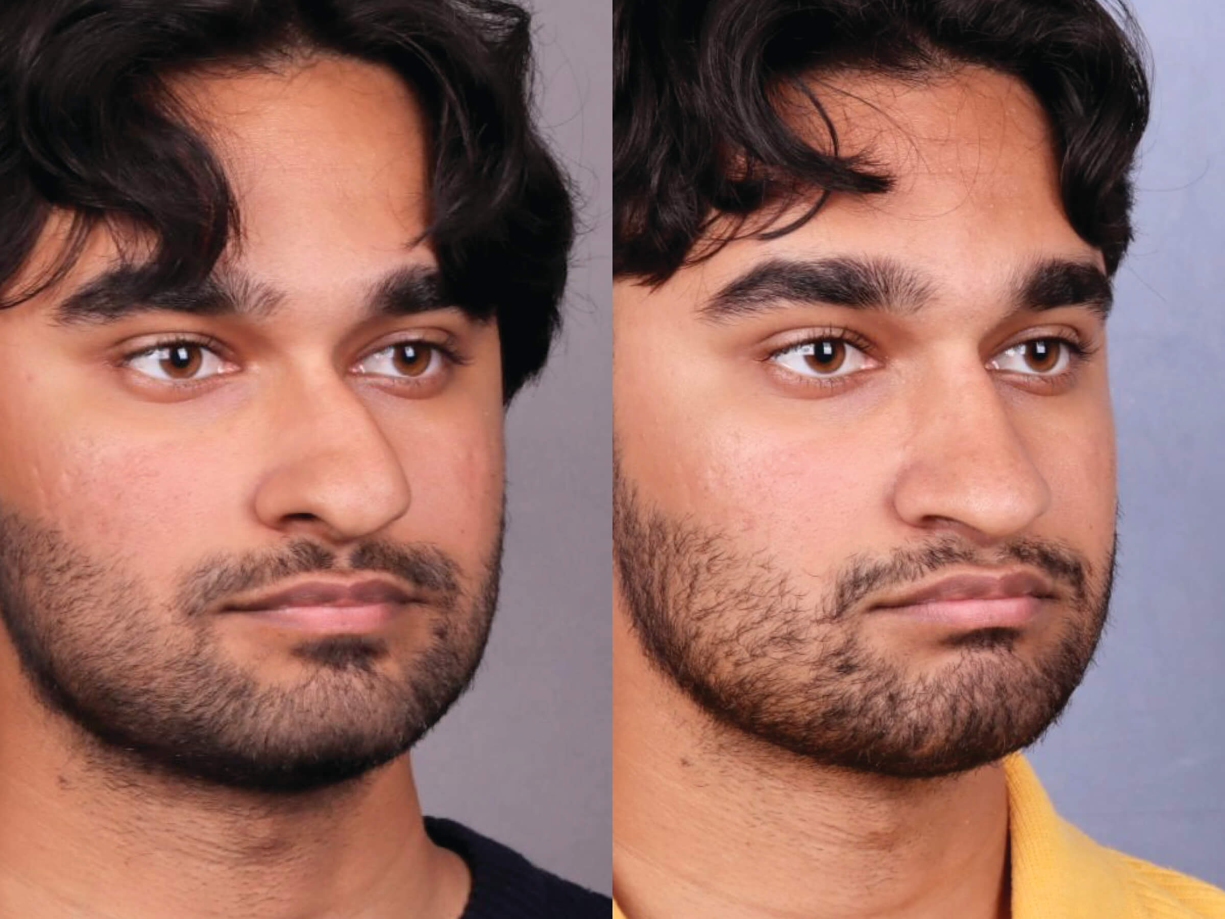 Before and After Image: Rhinoplasty - right-front-oblique