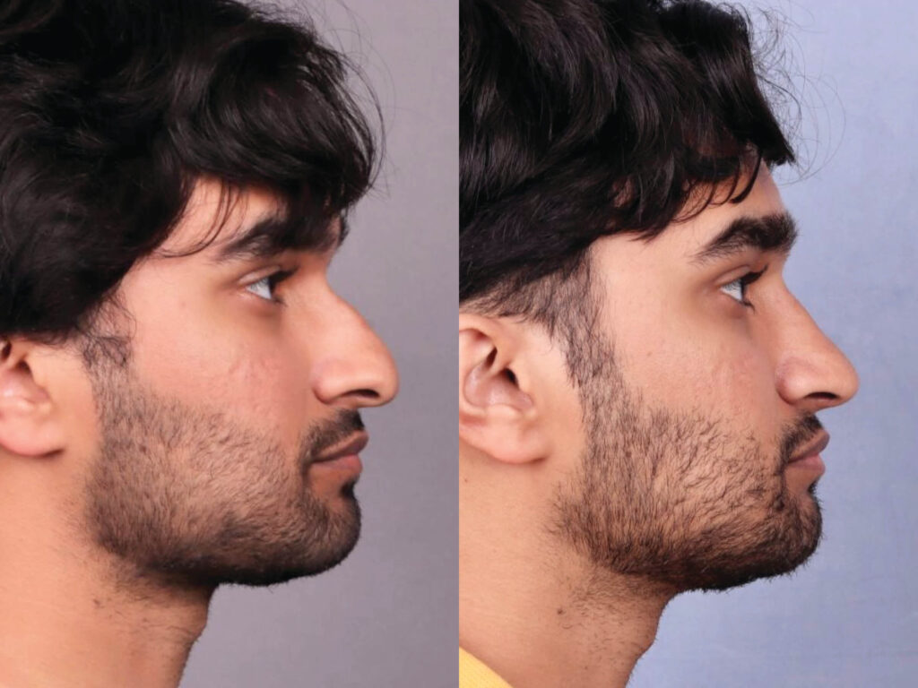 Before and After Image: Rhinoplasty - right-side