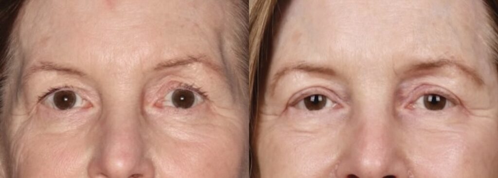 Before and After Image: Upper Blepharoplasty - front