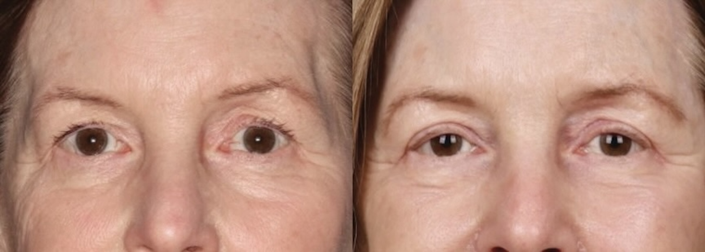 Before and After Image: Upper Blepharoplasty - front