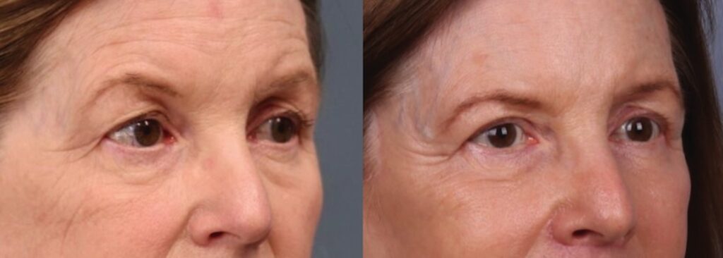 Before and After Image: Upper Blepharoplasty - right-front-oblique