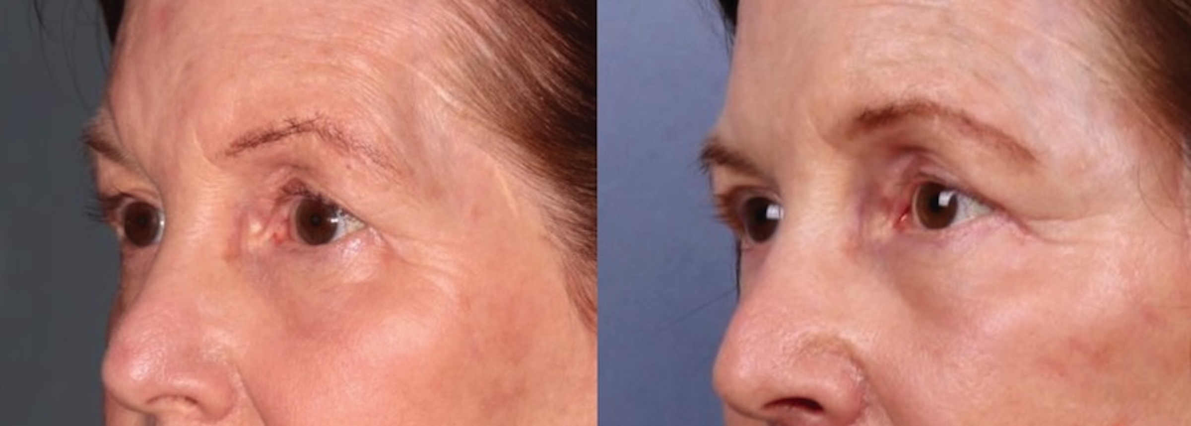 Before and After Image: Upper Blepharoplasty - left-front-oblique