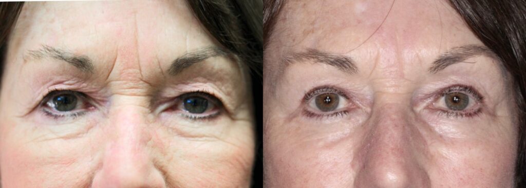 Before and After Image: Upper Blepharoplasty - front