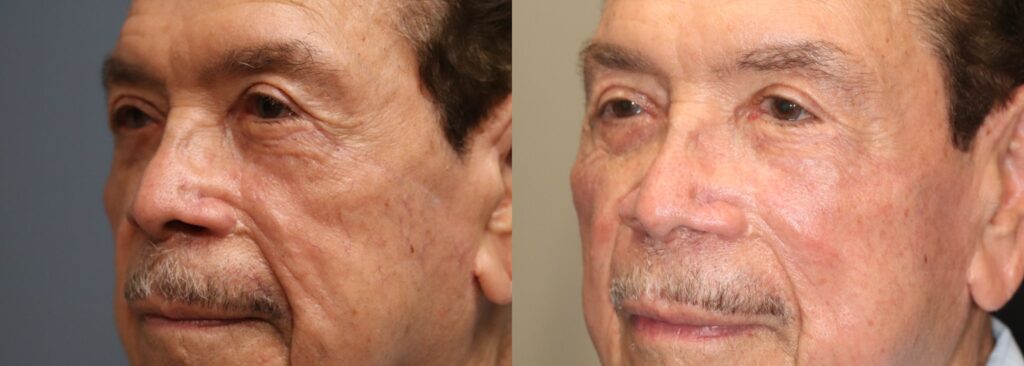Before and After Image: Upper Blepharoplasty - left-front-oblique