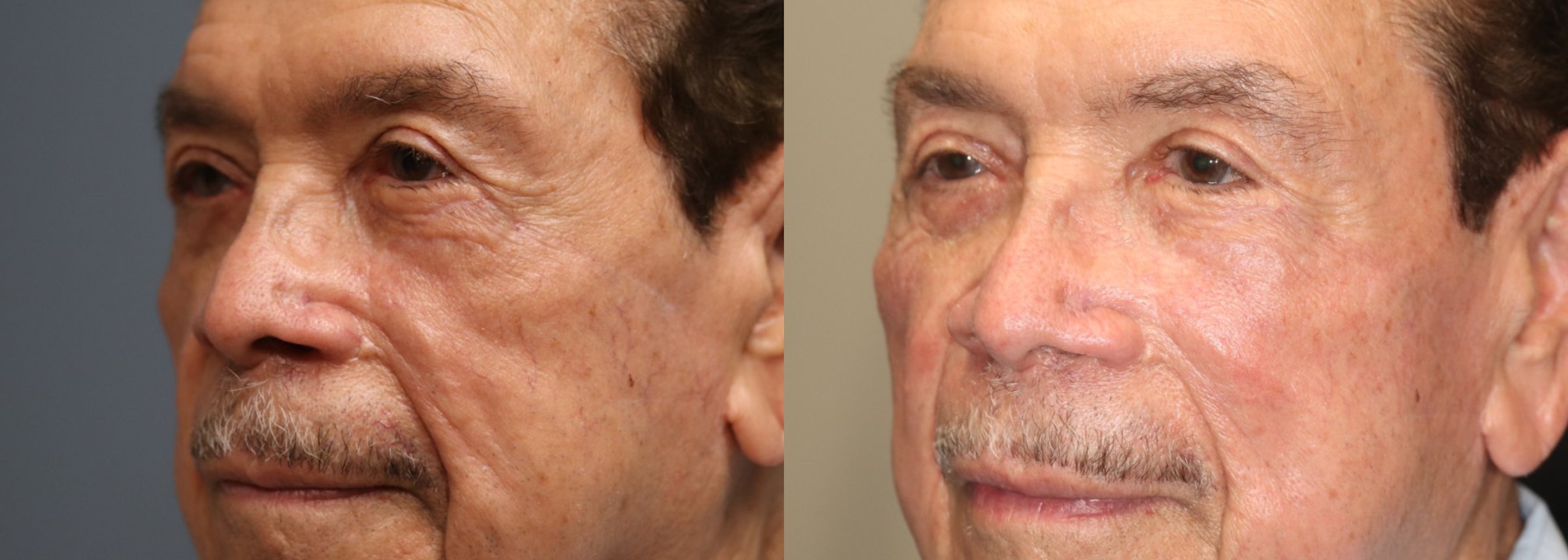Before and After Image: Upper Blepharoplasty - left-front-oblique