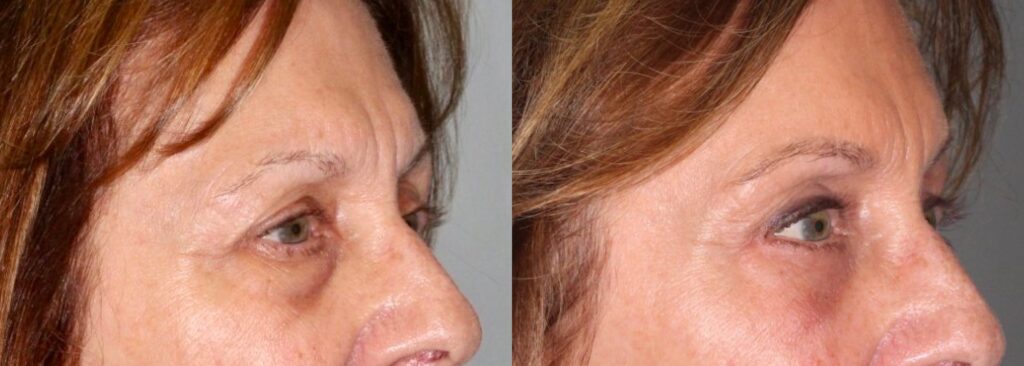 Before and After Image: Upper & Lower Blepharoplasty - right-front-oblique