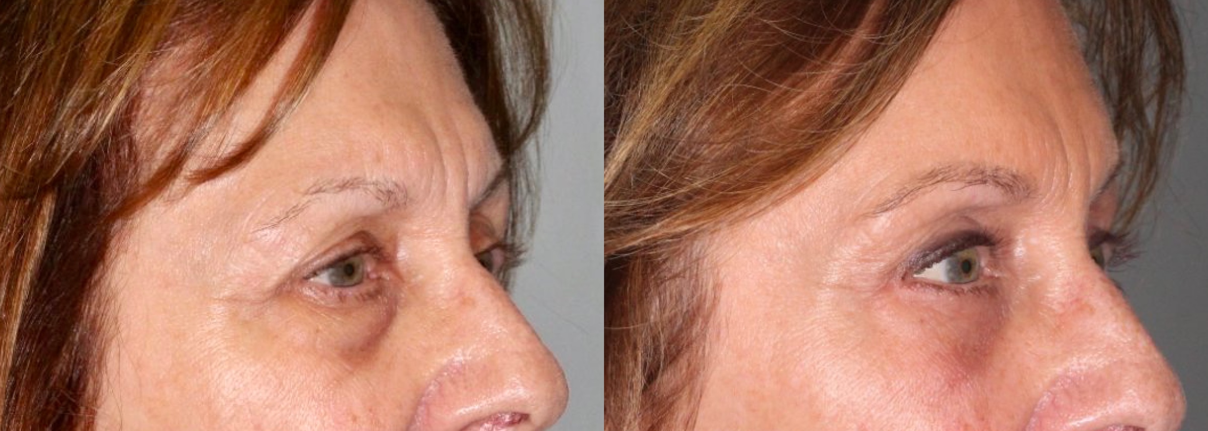 Before and After Image: Upper & Lower Blepharoplasty - right-front-oblique