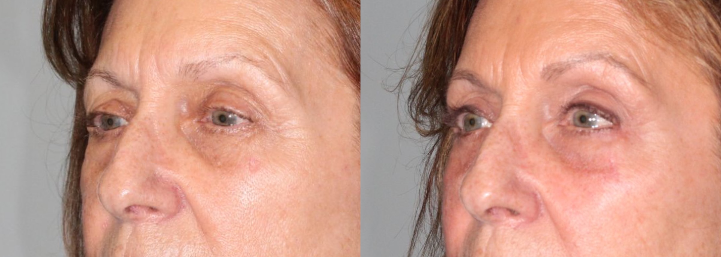 Before and After Image: Upper & Lower Blepharoplasty - left-front-oblique