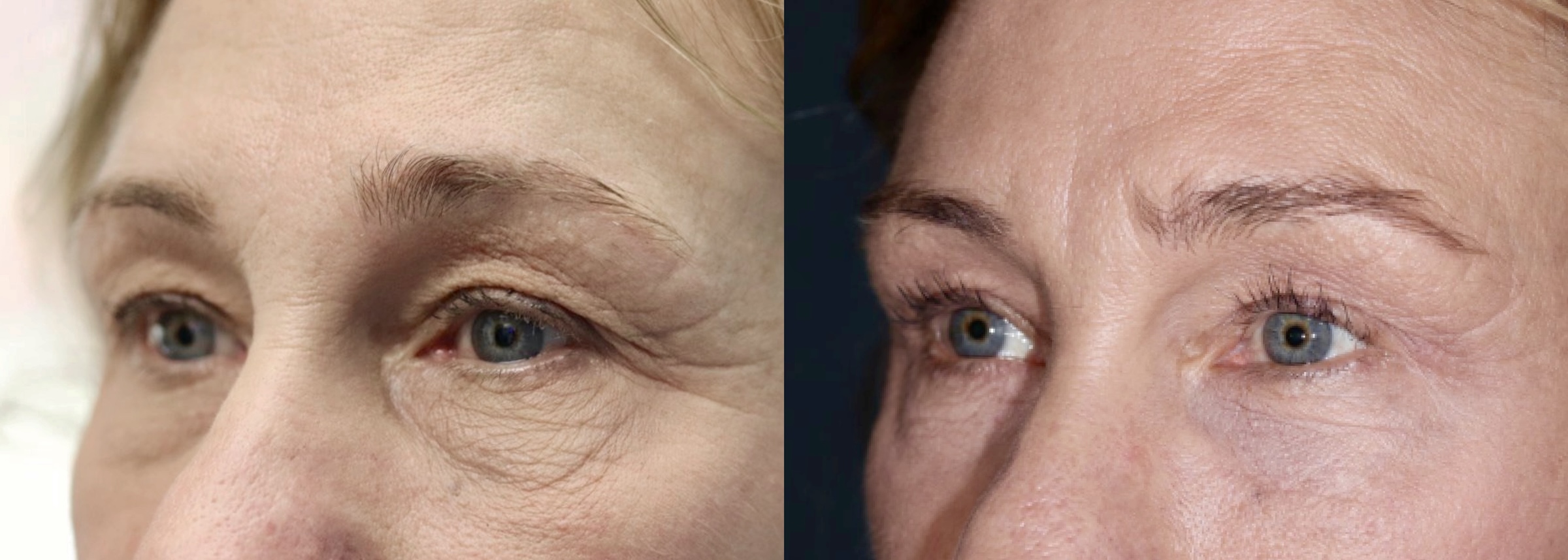Before and After Image: Upper Blepharoplasty - left-front-oblique