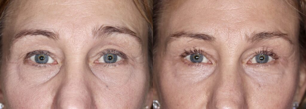 Before and After Image: Upper Blepharoplasty - front