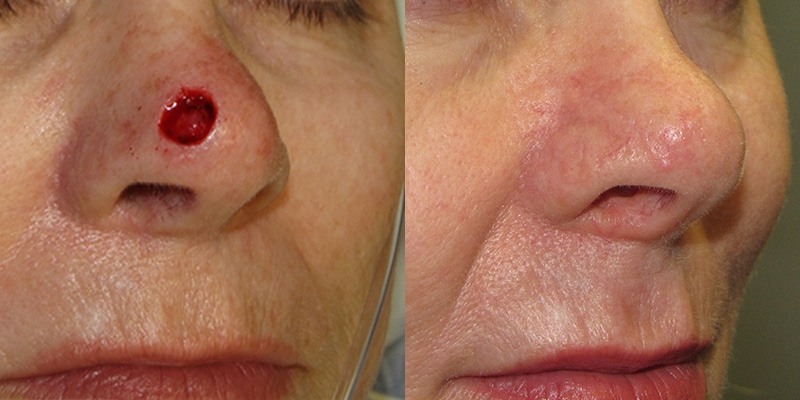 Before and After Image: Scar Treatments - right-front-oblique