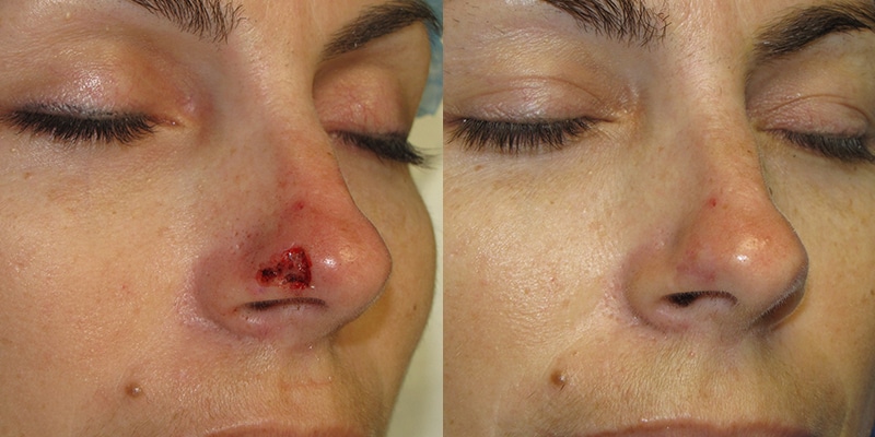 Before and After Image: Scar Treatments - right-front-oblique