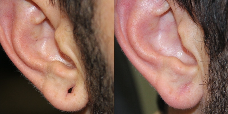 Before and After Image: Ear Surgery - right-side
