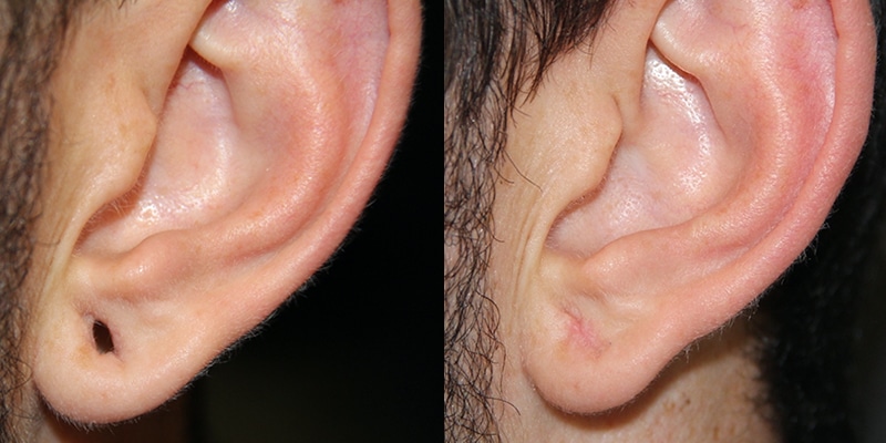 Before and After Image: Ear Surgery - left-side