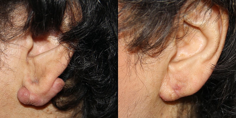 Before and After Image: Ear Surgery - left-side