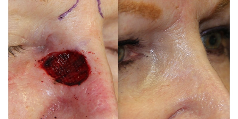 Before and After Image: Scar Treatments - right-front-oblique