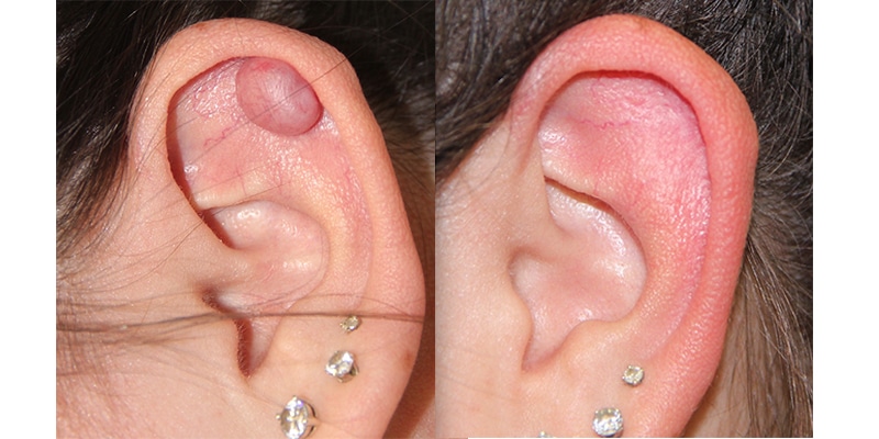 Before and After Image: Mole Removal - left-side