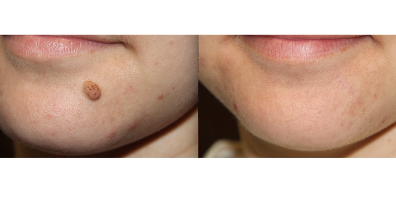 Before and After Image: Mole Removal - left-front-oblique
