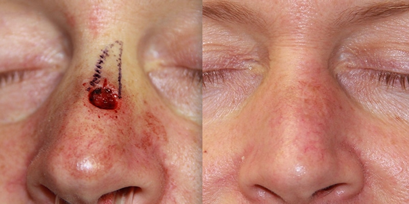 Before and After Image: Scar Treatments - front