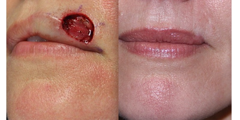 Before and After Image: Scar Treatments - left-front-oblique