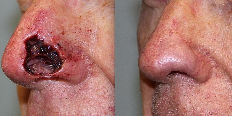 Before and After Image: Scar Treatments - left-front-oblique