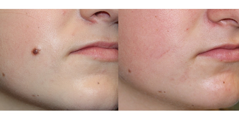 Before and After Image: Mole Removal - right-front-oblique