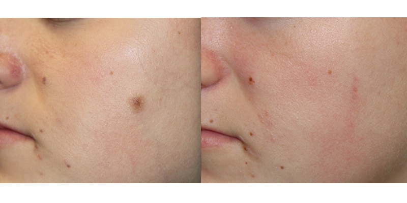 Before and After Image: Mole Removal - left-front-oblique