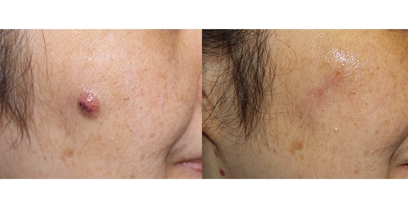 Before and After Image: Mole Removal - right-front-oblique