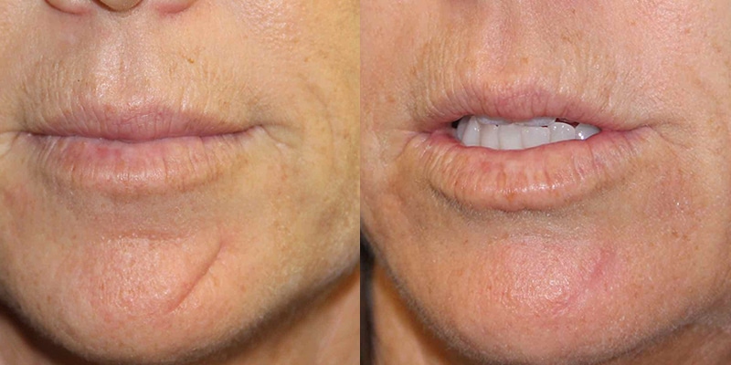 Before and After Image: Scar Treatments - left-front-oblique