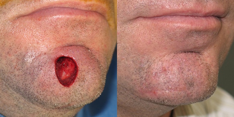Before and After Image: Scar Treatments - right-front-oblique