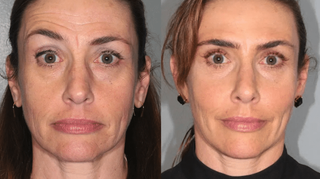 Before and After Image: Botox & Fillers - front