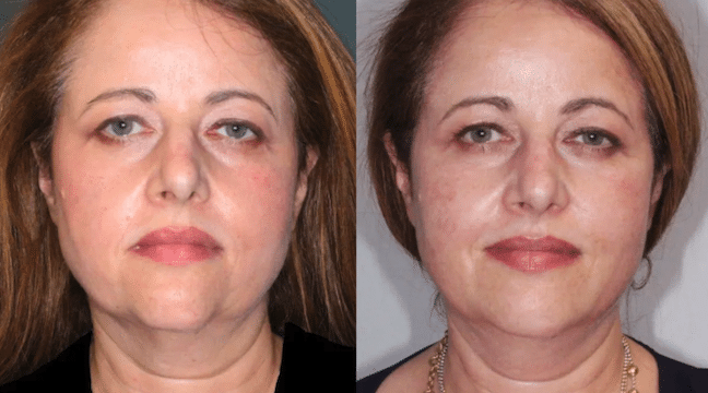 Before and After Image: Botox & Fillers - front