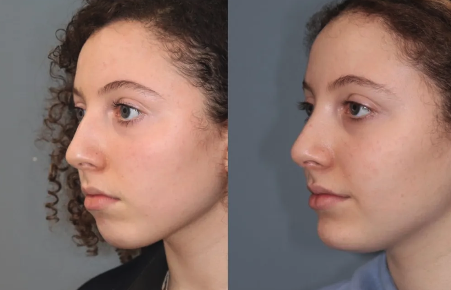 Before and After Image: Chin Surgery, Submentoplasty - left-front-oblique