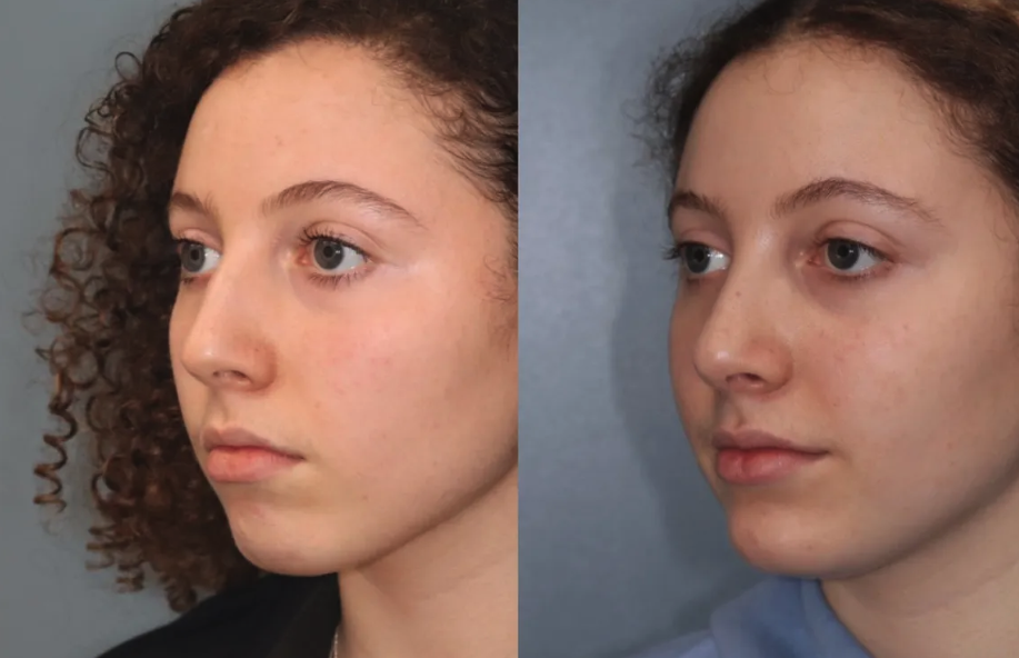 Before and After Image: Chin Surgery, Submentoplasty - left-front-oblique