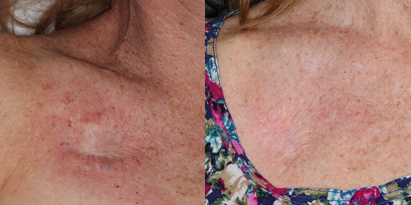 Before and After Image: Scar Treatments - front