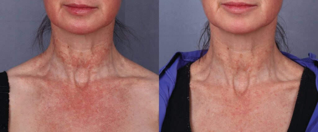 Before and After Image: CO2 Laser Resurfacing - front