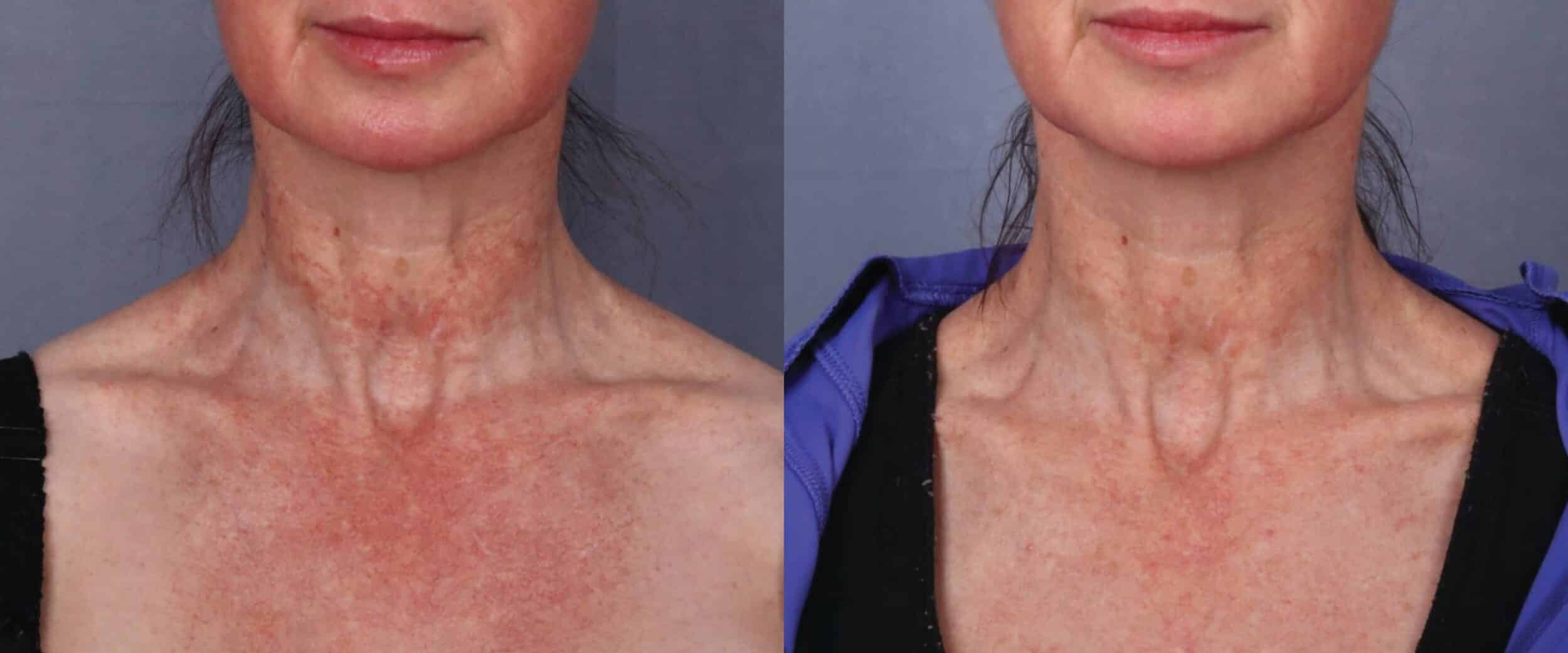 Before and After Image: CO2 Laser Resurfacing - front