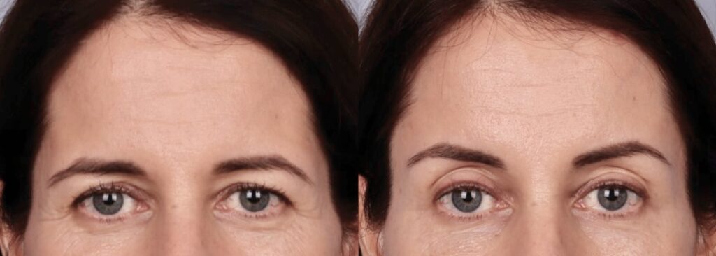 Before and After Image: Brow Lift - front