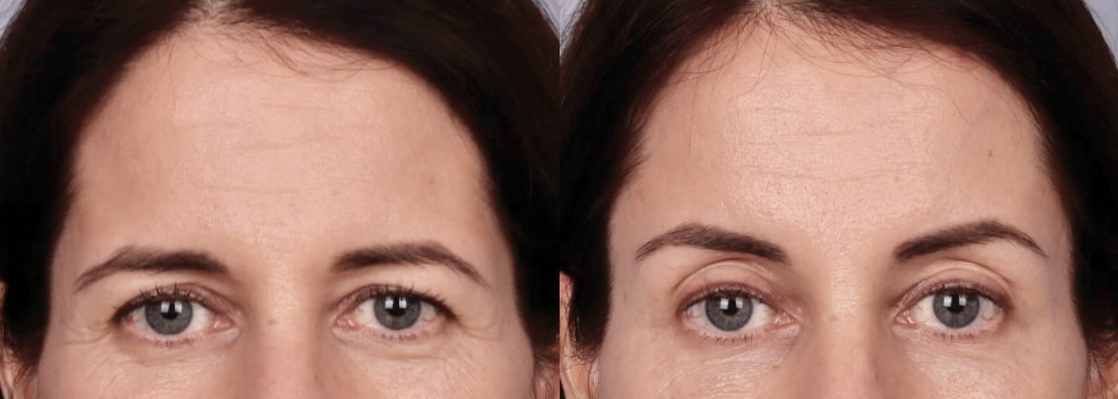 Before and After Image: Brow Lift - front