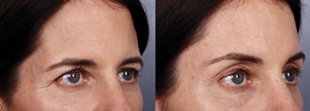 Before and After Image: Brow Lift - right-front-oblique