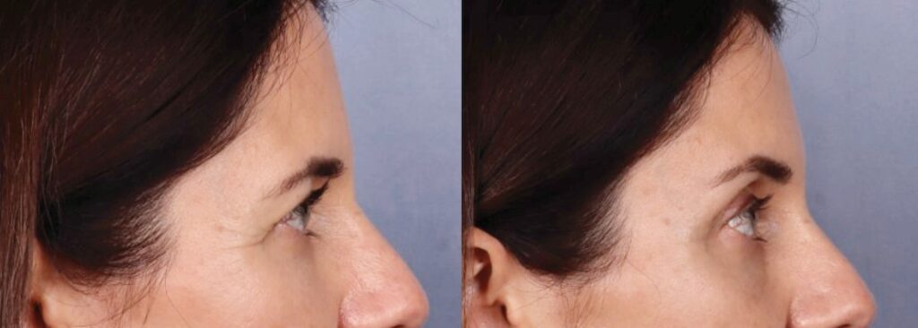 Before and After Image: Brow Lift - right-side