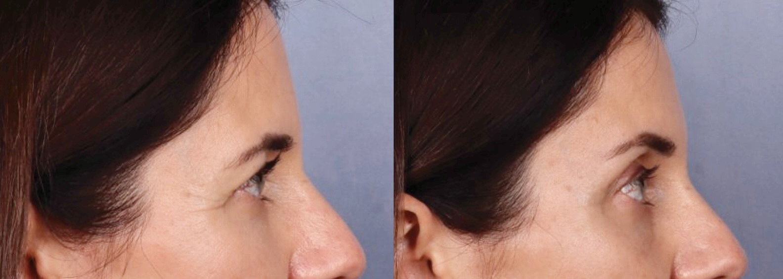 Before and After Image: Brow Lift - right-side