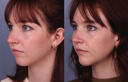 Before and After Image: Facial Volume Enhancement - left-front-oblique
