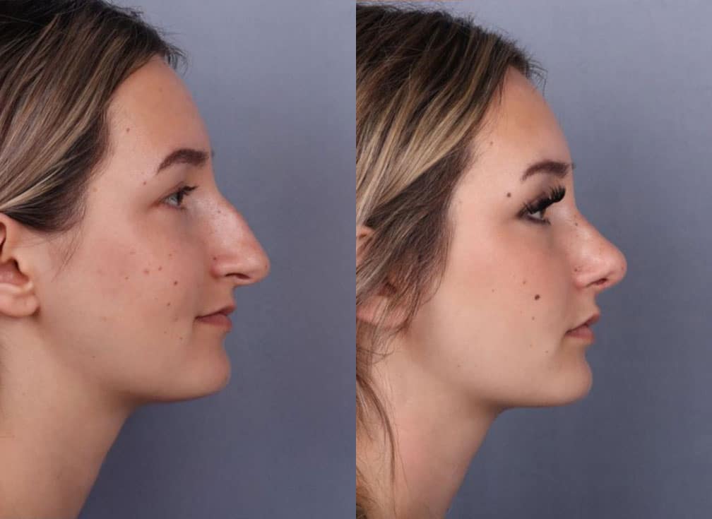 Before and After Image: Rhinoplasty - right-side