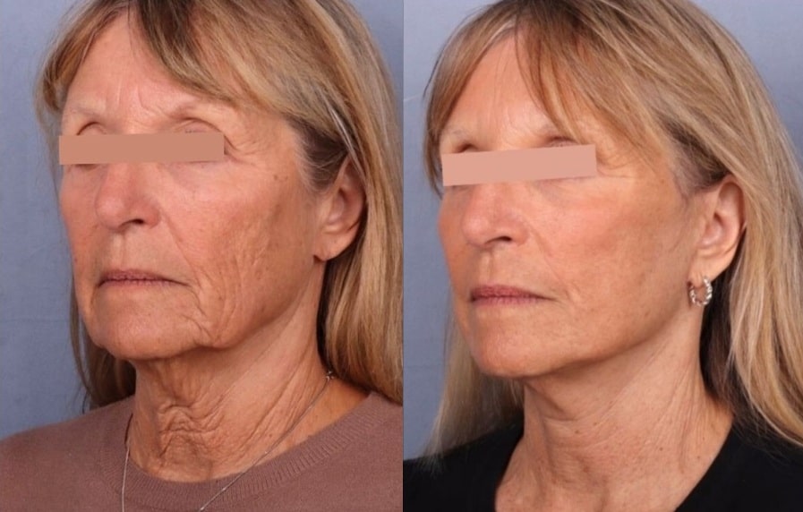 Before and After Image: Facelift & Neck Lift - front