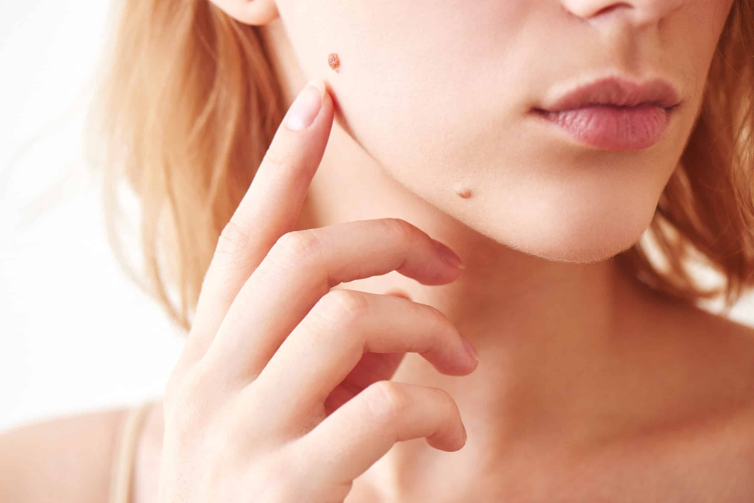 Cosmetic Mole Removal Newport Beach, CA
